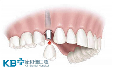 成人牙齿矫正的方法有哪些